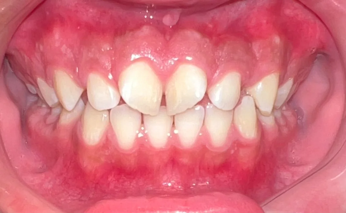 Caso Ortodoncia Inicio