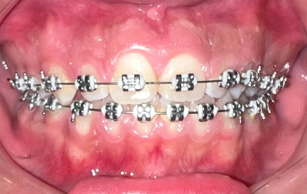 Caso Ortodoncia 6 meses