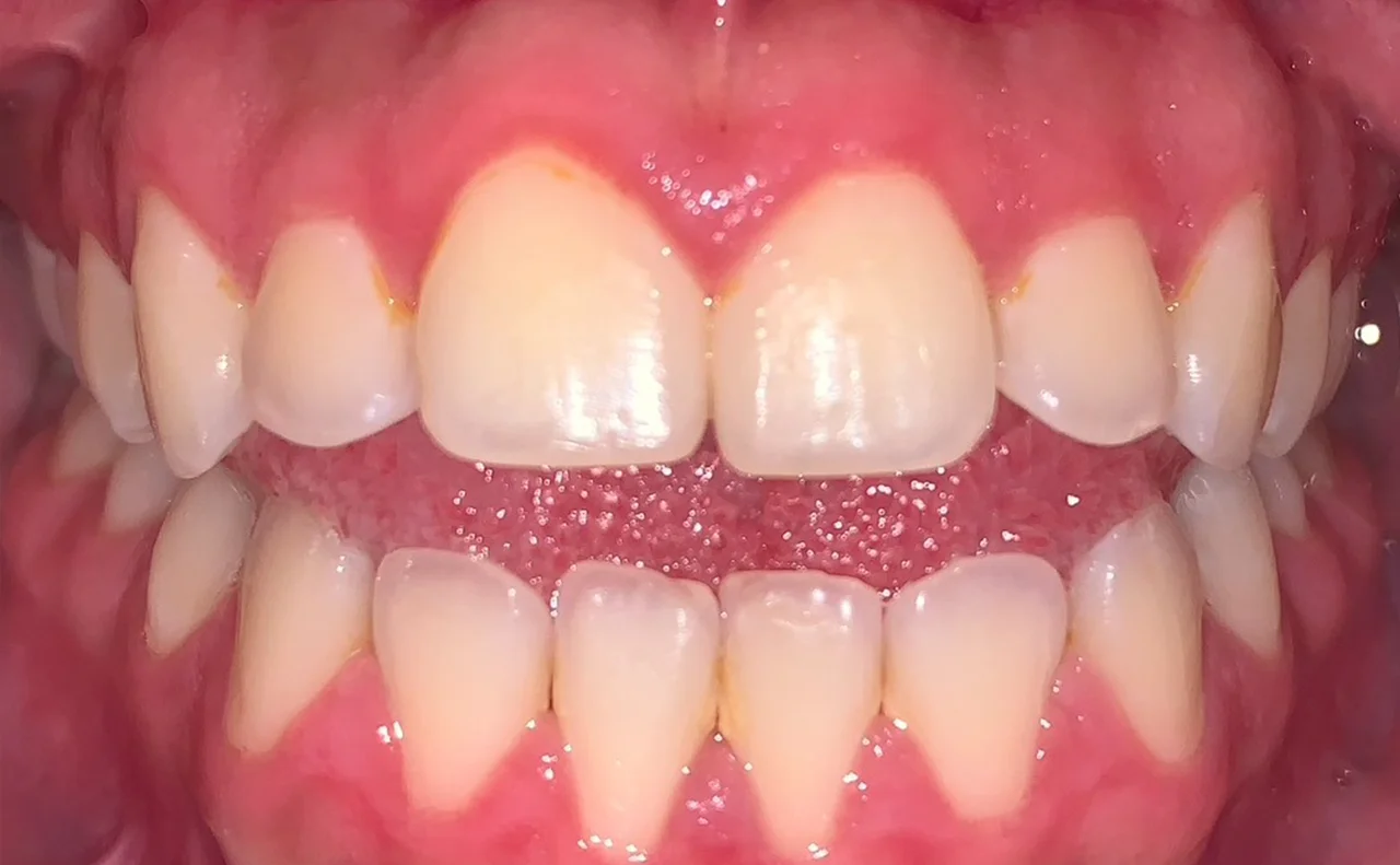 Caso Ortodoncia Inicio 2