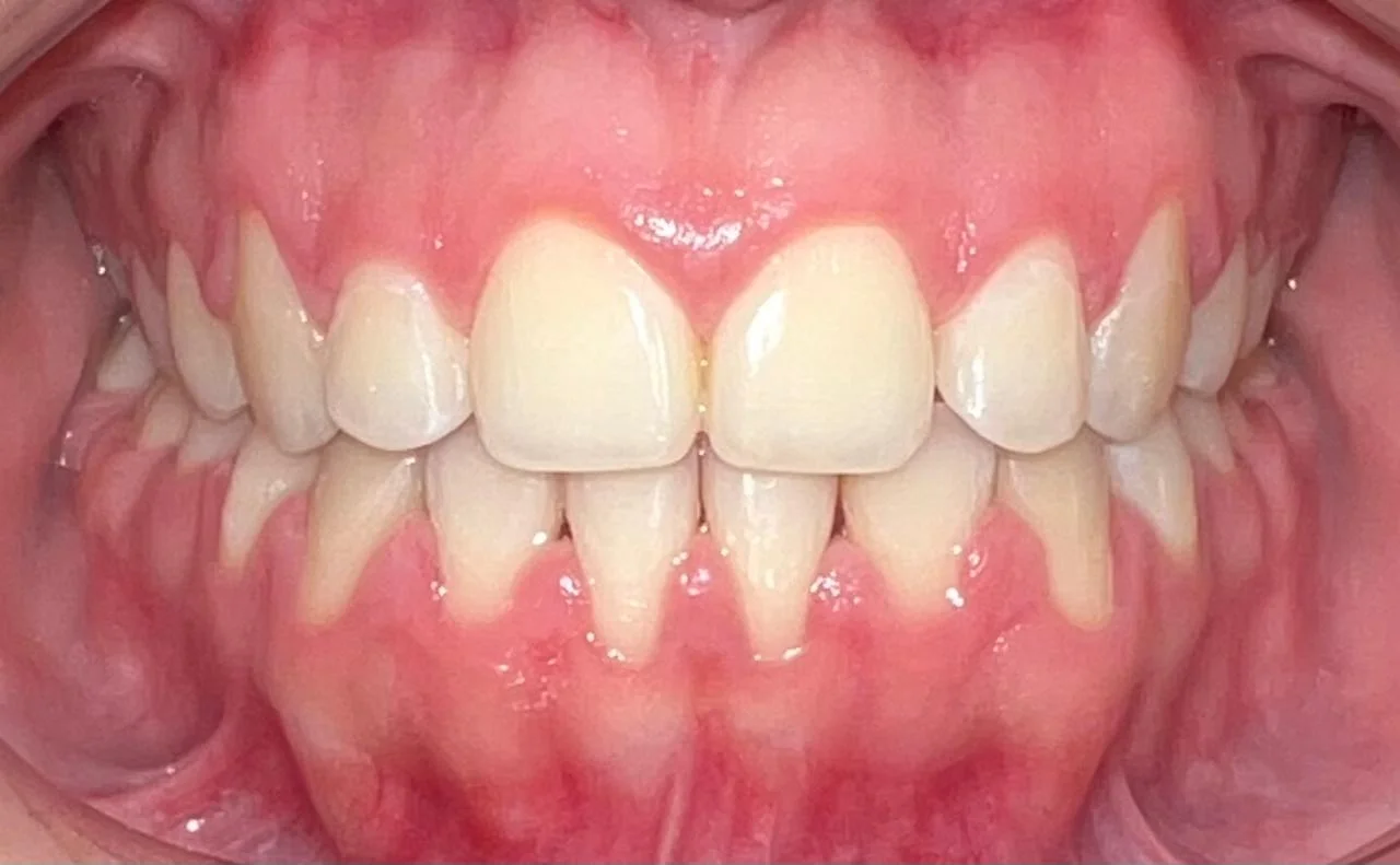 Caso Ortodoncia Finalizado