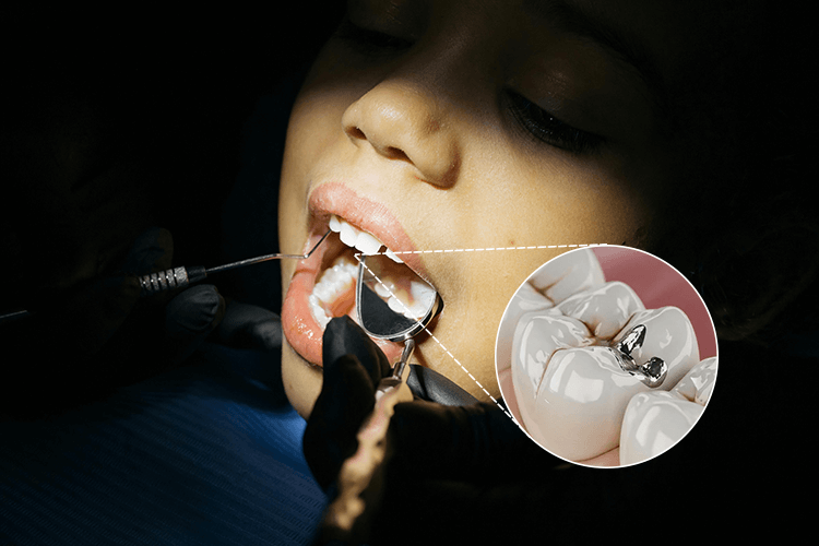 Primer plano de un empaste de amalgama dental en un molar. Primer plano de un empaste de amalgama dental en un molar.